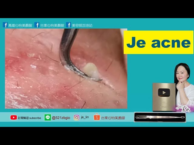 Je No pain Clear acne technology #無痛清粉刺技術 #台東心怡美顏館 #林季儀老師